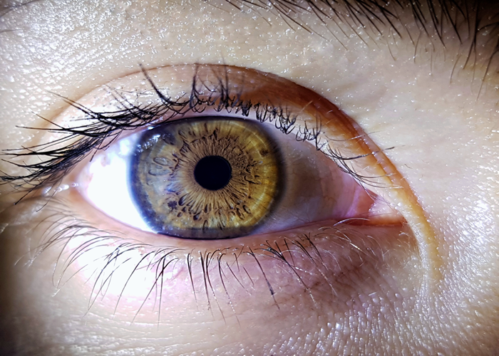 Avaliação integrada da produção, distribuição e drenagem do Filme Lacrimal, Anatomia das vias lacrimais

Anatomia funcional das vias lacrimais, destacando a glândula lacrimal, os pontos lacrimais, os canalículos, o saco lacrimal e o ducto nasolacrimal, estruturas responsáveis pela produção e drenagem fisiológica da lágrima.

O sistema lacrimal desempenha papel fundamental na manutenção da superfície ocular, proporcionando lubrificação, proteção imunológica, estabilidade óptica e conforto visual. Alterações discretas nesse sistema podem provocar sintomas importantes, como visão oscilante, ardor, sensação de areia, lacrimejamento excessivo e intolerância ao uso de lentes.

No Protocolo OptoPrime, a avaliação das vias lacrimais não é realizada apenas quando o paciente apresenta queixas de olho seco ou epífora (lacrimejamento excessivo dos olhos). Ela faz parte da investigação funcional da qualidade visual, pois a estabilidade do filme lacrimal influencia diretamente a refração, a sensibilidade ao contraste, a percepção de detalhes e o desempenho binocular.

Objetivos do Protocolo OptoPrime

A avaliação funcional das vias lacrimais busca:

Identificar alterações da produção lacrimal
A avaliação da produção lacrimal permite identificar alterações quantitativas da lágrima, fornecendo informações importantes sobre a lubrificação da superfície ocular e o equilíbrio do sistema lacrimal.

Avaliar a estabilidade do filme lacrimal, a estabilidade do filme lacrimal é essencial para manter a superfície ocular regular, favorecer a qualidade óptica e proporcionar conforto durante as atividades visuais.


Detectar sinais precoces de disfunção das glândulas palpebrais, a análise das glândulas palpebrais possibilita reconhecer precocemente alterações que podem comprometer a camada lipídica da lágrima e favorecer sua evaporação.

Investigar alterações da drenagem lacrimal, a investigação do sistema de drenagem lacrimal auxilia na identificação de alterações funcionais relacionadas ao escoamento da lágrima, contribuindo para uma avaliação clínica mais abrangente.


Diferenciar lacrimejamento reflexo de deficiência lacrimal
A diferenciação entre lacrimejamento reflexo e redução da produção lacrimal é importante para direcionar a interpretação dos sinais clínicos e orientar a conduta adequada durante a avaliação optométrica.

Reduzir a probabilidade de erros refracionais decorrentes da instabilidade do filme lacrimal
No Protocolo OptoPrime, a estabilização da superfície ocular antes do refinamento refracional contribui para aumentar a confiabilidade dos resultados e reduzir a probabilidade de variações induzidas pela instabilidade do filme lacrimal.


Anatomia Funcional

O sistema lacrimal é dividido em dois grandes componentes:

Sistema Secretor
O sistema secretor é formado por glândulas especializadas que produzem os diferentes componentes do filme lacrimal, contribuindo para a lubrificação, proteção e estabilidade óptica da superfície ocular.

Responsável pela produção da lágrima, inclui:

Glândula lacrimal principal
A glândula lacrimal principal é responsável pela maior parte da produção aquosa da lágrima, desempenhando papel importante na proteção, hidratação e resposta reflexa da superfície ocular.

Glândulas lacrimais acessórias
As glândulas lacrimais acessórias contribuem para a manutenção contínua do filme lacrimal, auxiliando na lubrificação fisiológica da superfície ocular durante as atividades diárias.

Glândulas de Meibômio
As glândulas de Meibômio produzem a camada lipídica do filme lacrimal, reduzindo a evaporação da lágrima e favorecendo maior estabilidade e conforto visual.

Glândulas de Zeis
As glândulas de Zeis estão associadas aos folículos ciliares e participam da produção de secreção lipídica que auxilia na proteção da margem palpebral.

Glândulas de Moll
As glândulas de Moll localizam-se na margem das pálpebras e contribuem para a manutenção do ambiente palpebral, integrando o sistema secretor da superfície ocular.

Células caliciformes da conjuntiva
As células caliciformes produzem mucinas que promovem a aderência da lágrima à superfície ocular, favorecendo a uniformidade do filme lacrimal e a qualidade óptica da córnea.


Cada estrutura contribui para a estabilidade do filme lacrimal.

Sistema Excretor
O sistema excretor é responsável pela drenagem fisiológica da lágrima, permitindo o escoamento adequado do excesso de secreção para a cavidade nasal.


Responsável pela drenagem fisiológica

Compreende:

Pontos lacrimais
Os pontos lacrimais constituem a porta de entrada do sistema de drenagem, captando a lágrima presente na margem palpebral durante o piscar.

Canalículos lacrimais
Os canalículos lacrimais conduzem a lágrima dos pontos lacrimais em direção ao saco lacrimal, participando do mecanismo fisiológico de drenagem.

Canalículo comum
O canalículo comum representa a união dos canalículos superior e inferior antes da chegada da lágrima ao saco lacrimal.

Saco lacrimal
O saco lacrimal funciona como reservatório temporário da lágrima antes de sua drenagem pelo ducto nasolacrimal.

Ducto nasolacrimal
O ducto nasolacrimal conduz a lágrima até a cavidade nasal, completando o processo fisiológico de drenagem do sistema lacrimal.


Qualquer obstrução nesse trajeto pode resultar em epífora e aumento do risco de infecções.

Estrutura do Filme Lacrimal

No Protocolo OptoPrime, o filme lacrimal é compreendido como uma estrutura dinâmica composta por três componentes funcionais.

Camada Lipídica, localizada externamente
Localizada na porção mais externa do filme lacrimal, a camada lipídica atua como uma barreira protetora contra a evaporação excessiva da lágrima, contribuindo para a estabilidade do filme lacrimal, a manutenção da superfície ocular e a otimização da qualidade óptica durante a formação da imagem retiniana.


Principais funções:

Reduzir evaporação
A camada lipídica, produzida principalmente pelas glândulas de Meibômio, reduz a evaporação da lágrima e favorece a estabilidade do filme lacrimal, desempenhando papel importante no conforto ocular e na qualidade da visão.

Estabilizar o filme lacrimal
A estabilidade do filme lacrimal mantém a superfície ocular uniformemente recoberta pela lágrima, reduzindo irregularidades ópticas e contribuindo para uma visão mais estável e confortável durante o piscar.

Melhorar a qualidade óptica da superfície ocular
Um filme lacrimal íntegro favorece a formação de uma superfície óptica regular sobre a córnea, reduzindo a dispersão da luz e contribuindo para maior nitidez, contraste e qualidade visual.

Sua deficiência favorece o olho seco evaporativo
a avaliação da camada lipídica do filme lacrimal auxilia na identificação de alterações que podem comprometer a estabilidade da superfície ocular, interferir na qualidade visual e influenciar a confiabilidade da avaliação refracional.


Camada Aquosa, representa a maior parte do volume lacrimal

Funções:

Hidratação da córnea
A camada aquosa do filme lacrimal mantém a hidratação contínua da córnea, preservando a transparência, a integridade do epitélio e o conforto durante as atividades visuais.

Transporte de nutrientes
A lágrima atua como meio de transporte para oxigênio, eletrólitos, proteínas e outros nutrientes essenciais, contribuindo para o metabolismo e a manutenção da superfície ocular.

Remoção de partículas
O fluxo fisiológico da lágrima auxilia na remoção de poeira, microrganismos e resíduos presentes na superfície ocular, favorecendo a limpeza e a proteção dos tecidos oculares.

Defesa imunológica
Além de lubrificar a superfície ocular, o filme lacrimal contém componentes de defesa que contribuem para a proteção contra agentes potencialmente nocivos e para a manutenção do equilíbrio da microbiota ocular.

Camada de Mucinas
A camada de mucinas permanece aderida ao epitélio ocular, promovendo maior aderência da lágrima à superfície da córnea e da conjuntiva, favorecendo a estabilidade do filme lacrimal.

As mucinas aumentam a capacidade de adesão da lágrima ao epitélio ocular, reduzindo áreas de instabilidade e melhorando a cobertura da superfície ocular.

Funções:

Fica aderida ao epitélio ocular a aderência da lágrima

A aderência da camada de mucinas ao epitélio ocular permite a distribuição uniforme da lágrima durante o piscar, contribuindo para uma superfície óptica mais regular e confortável. 

Uniformizar a superfície óptica
A distribuição homogênea das mucinas contribui para formar uma superfície refrativa mais regular, favorecendo a qualidade da imagem projetada na retina.

Promover melhor espalhamento do filme lacrimal.
Durante o piscar, a camada de mucinas facilita o espalhamento uniforme do filme lacrimal sobre a superfície ocular, contribuindo para maior estabilidade visual e conforto., Avaliação da superfície ocular, Protocolo optoprime, em, Óptica e Optometria