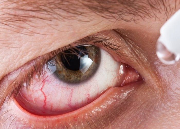 Opto Prime Manaus, Parece contraditório, não mas veja que o olho pode estar seco mesmo lacrimejando muito. Isso é mais comum do que parece, especialmente em idosos e em pessoas com doenças crônicas como diabetes.

Então vamos entender por que isso acontece:

Veja  como é o mecanismo :

A superfície do olho (córnea e conjuntiva) fica irritada ou ressecada, por uso de colírio, vento, idade, baixa produção de lágrima basal ou má qualidade da lágrima.

O cérebro interpreta essa irritação como falta de lubrificação.

Em resposta, envia um comando reflexo para produzir mais lágrimas,  mas essas lágrimas são do tipo aquoso, irritativa, não possuem a composição ideal.

O excesso dessa lágrima aquosa escorre pelos olhos (epífora), sem hidratar adequadamente a superfície.

#exameoptoprime, #examedevistamanaus, #examedevistamanoa, #olhoseco, #lacrimejamento, #vistaembacada
, Visão embaçada após os 60 anos, Dificuldades de aprendizagem, em, Óptica e Optometria