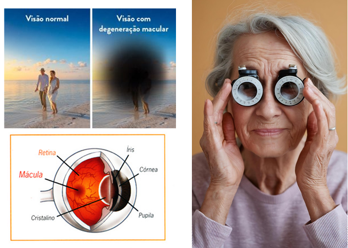 Degeneração Macular Relacionada à Idade (DMRI) -  Como prevenir a perda da visão, A visão é um dos sentidos mais importantes para a qualidade de vida, especialmente durante o envelhecimento. No entanto, com o passar dos anos, algumas alterações naturais podem comprometer a saúde ocular. Uma das condições mais comuns e preocupantes nesse processo é a Degeneração Macular Relacionada à Idade (DMRI).

A DMRI é uma doença crônica e progressiva que afeta a mácula, uma pequena área no centro da retina responsável pela visão central e pelos detalhes finos, como ler, dirigir ou reconhecer rostos. Essa condição ocorre principalmente em pessoas com mais de 60 anos e é considerada uma das principais causas de perda da visão central em idosos.

Embora a DMRI não cause cegueira total, ela pode tornar tarefas simples do dia a dia extremamente desafiadoras. Existem dois tipos principais da doença: a forma seca, mais comum e de progressão lenta, e a forma úmida, menos comum, porém mais agressiva e rápida.

A boa notícia é que, com a detecção precoce, mudanças no estilo de vida, acompanhamento optométrico e orientações profissionais de saúde, é possível retardar a progressão da DMRI e melhorar a qualidade de vida das pessoas afetadas., Exame de Vista, Márcia Sousa Optometrista, em, Óptica e Optometria