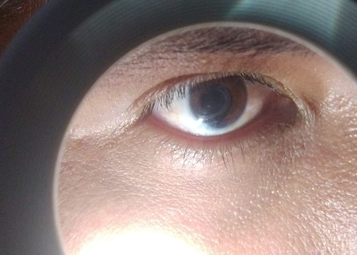 Vias lacrimais, Anatomia das vias lacrimais

Anatomia funcional das vias lacrimais, destacando a glândula lacrimal, os pontos lacrimais, os canalículos, o saco lacrimal e o ducto nasolacrimal, estruturas responsáveis pela produção e drenagem fisiológica da lágrima.

O sistema lacrimal desempenha papel fundamental na manutenção da superfície ocular, proporcionando lubrificação, proteção imunológica, estabilidade óptica e conforto visual. Alterações discretas nesse sistema podem provocar sintomas importantes, como visão oscilante, ardor, sensação de areia, lacrimejamento excessivo e intolerância ao uso de lentes.

No Protocolo OptoPrime, a avaliação das vias lacrimais não é realizada apenas quando o paciente apresenta queixas de olho seco ou epífora (lacrimejamento excessivo dos olhos). Ela faz parte da investigação funcional da qualidade visual, pois a estabilidade do filme lacrimal influencia diretamente a refração, a sensibilidade ao contraste, a percepção de detalhes e o desempenho binocular.

Objetivos do Protocolo OptoPrime

A avaliação funcional das vias lacrimais busca:

Identificar alterações da produção lacrimal
A avaliação da produção lacrimal permite identificar alterações quantitativas da lágrima, fornecendo informações importantes sobre a lubrificação da superfície ocular e o equilíbrio do sistema lacrimal.

Avaliar a estabilidade do filme lacrimal, a estabilidade do filme lacrimal é essencial para manter a superfície ocular regular, favorecer a qualidade óptica e proporcionar conforto durante as atividades visuais.


Detectar sinais precoces de disfunção das glândulas palpebrais, a análise das glândulas palpebrais possibilita reconhecer precocemente alterações que podem comprometer a camada lipídica da lágrima e favorecer sua evaporação.

Investigar alterações da drenagem lacrimal, a investigação do sistema de drenagem lacrimal auxilia na identificação de alterações funcionais relacionadas ao escoamento da lágrima, contribuindo para uma avaliação clínica mais abrangente.


Diferenciar lacrimejamento reflexo de deficiência lacrimal
A diferenciação entre lacrimejamento reflexo e redução da produção lacrimal é importante para direcionar a interpretação dos sinais clínicos e orientar a conduta adequada durante a avaliação optométrica.

Reduzir a probabilidade de erros refracionais decorrentes da instabilidade do filme lacrimal
No Protocolo OptoPrime, a estabilização da superfície ocular antes do refinamento refracional contribui para aumentar a confiabilidade dos resultados e reduzir a probabilidade de variações induzidas pela instabilidade do filme lacrimal.


Anatomia Funcional

O sistema lacrimal é dividido em dois grandes componentes:

Sistema Secretor
O sistema secretor é formado por glândulas especializadas que produzem os diferentes componentes do filme lacrimal, contribuindo para a lubrificação, proteção e estabilidade óptica da superfície ocular.

Responsável pela produção da lágrima, inclui:

Glândula lacrimal principal
A glândula lacrimal principal é responsável pela maior parte da produção aquosa da lágrima, desempenhando papel importante na proteção, hidratação e resposta reflexa da superfície ocular.

Glândulas lacrimais acessórias
As glândulas lacrimais acessórias contribuem para a manutenção contínua do filme lacrimal, auxiliando na lubrificação fisiológica da superfície ocular durante as atividades diárias.

Glândulas de Meibômio
As glândulas de Meibômio produzem a camada lipídica do filme lacrimal, reduzindo a evaporação da lágrima e favorecendo maior estabilidade e conforto visual.

Glândulas de Zeis
As glândulas de Zeis estão associadas aos folículos ciliares e participam da produção de secreção lipídica que auxilia na proteção da margem palpebral.

Glândulas de Moll
As glândulas de Moll localizam-se na margem das pálpebras e contribuem para a manutenção do ambiente palpebral, integrando o sistema secretor da superfície ocular.

Células caliciformes da conjuntiva
As células caliciformes produzem mucinas que promovem a aderência da lágrima à superfície ocular, favorecendo a uniformidade do filme lacrimal e a qualidade óptica da córnea.


Cada estrutura contribui para a estabilidade do filme lacrimal.

Sistema Excretor
O sistema excretor é responsável pela drenagem fisiológica da lágrima, permitindo o escoamento adequado do excesso de secreção para a cavidade nasal.


Responsável pela drenagem fisiológica

Compreende:

Pontos lacrimais
Os pontos lacrimais constituem a porta de entrada do sistema de drenagem, captando a lágrima presente na margem palpebral durante o piscar.

Canalículos lacrimais
Os canalículos lacrimais conduzem a lágrima dos pontos lacrimais em direção ao saco lacrimal, participando do mecanismo fisiológico de drenagem.

Canalículo comum
O canalículo comum representa a união dos canalículos superior e inferior antes da chegada da lágrima ao saco lacrimal.

Saco lacrimal
O saco lacrimal funciona como reservatório temporário da lágrima antes de sua drenagem pelo ducto nasolacrimal.

Ducto nasolacrimal
O ducto nasolacrimal conduz a lágrima até a cavidade nasal, completando o processo fisiológico de drenagem do sistema lacrimal.


Qualquer obstrução nesse trajeto pode resultar em epífora e aumento do risco de infecções.

Estrutura do Filme Lacrimal

No Protocolo OptoPrime, o filme lacrimal é compreendido como uma estrutura dinâmica composta por três componentes funcionais.

Camada Lipídica, localizada externamente
Localizada na porção mais externa do filme lacrimal, a camada lipídica atua como uma barreira protetora contra a evaporação excessiva da lágrima, contribuindo para a estabilidade do filme lacrimal, a manutenção da superfície ocular e a otimização da qualidade óptica durante a formação da imagem retiniana.


Principais funções:

Reduzir evaporação
A camada lipídica, produzida principalmente pelas glândulas de Meibômio, reduz a evaporação da lágrima e favorece a estabilidade do filme lacrimal, desempenhando papel importante no conforto ocular e na qualidade da visão.

Estabilizar o filme lacrimal
A estabilidade do filme lacrimal mantém a superfície ocular uniformemente recoberta pela lágrima, reduzindo irregularidades ópticas e contribuindo para uma visão mais estável e confortável durante o piscar.

Melhorar a qualidade óptica da superfície ocular
Um filme lacrimal íntegro favorece a formação de uma superfície óptica regular sobre a córnea, reduzindo a dispersão da luz e contribuindo para maior nitidez, contraste e qualidade visual.

Sua deficiência favorece o olho seco evaporativo
a avaliação da camada lipídica do filme lacrimal auxilia na identificação de alterações que podem comprometer a estabilidade da superfície ocular, interferir na qualidade visual e influenciar a confiabilidade da avaliação refracional.


Camada Aquosa, representa a maior parte do volume lacrimal

Funções:

Hidratação da córnea
A camada aquosa do filme lacrimal mantém a hidratação contínua da córnea, preservando a transparência, a integridade do epitélio e o conforto durante as atividades visuais.

Transporte de nutrientes
A lágrima atua como meio de transporte para oxigênio, eletrólitos, proteínas e outros nutrientes essenciais, contribuindo para o metabolismo e a manutenção da superfície ocular.

Remoção de partículas
O fluxo fisiológico da lágrima auxilia na remoção de poeira, microrganismos e resíduos presentes na superfície ocular, favorecendo a limpeza e a proteção dos tecidos oculares.

Defesa imunológica
Além de lubrificar a superfície ocular, o filme lacrimal contém componentes de defesa que contribuem para a proteção contra agentes potencialmente nocivos e para a manutenção do equilíbrio da microbiota ocular.

Camada de Mucinas
A camada de mucinas permanece aderida ao epitélio ocular, promovendo maior aderência da lágrima à superfície da córnea e da conjuntiva, favorecendo a estabilidade do filme lacrimal.

As mucinas aumentam a capacidade de adesão da lágrima ao epitélio ocular, reduzindo áreas de instabilidade e melhorando a cobertura da superfície ocular.

Funções:

Fica aderida ao epitélio ocular a aderência da lágrima

A aderência da camada de mucinas ao epitélio ocular permite a distribuição uniforme da lágrima durante o piscar, contribuindo para uma superfície óptica mais regular e confortável. 

Uniformizar a superfície óptica
A distribuição homogênea das mucinas contribui para formar uma superfície refrativa mais regular, favorecendo a qualidade da imagem projetada na retina.

Promover melhor espalhamento do filme lacrimal.
Durante o piscar, a camada de mucinas facilita o espalhamento uniforme do filme lacrimal sobre a superfície ocular, contribuindo para maior estabilidade visual e conforto., Avaliação da superfície ocular, Protocolo optoprime, em, Óptica e Optometria