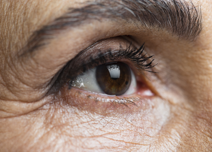 Visão embaçada sem cirurgia prévia pode ter muitas causas, A visão embaçada é um sintoma comum que pode surgir de forma repentina ou progressiva, afetando um ou ambos os olhos. Muitas pessoas acreditam que esse sintoma só aparece após traumas ou cirurgias, mas na verdade, há uma variedade de causas que não têm relação direta com procedimentos cirúrgicos. Saber reconhecer essas causas e buscar ajuda qualificada é essencial para evitar complicações visuais mais graves.

A Clínica Opto Prime, especializada em atenção primária à saúde visual, atua justamente na investigação precoce de sinais como a visão embaçada. Com avaliação optométrica clínica, é possível identificar desde simples alterações de refração até sinais de doenças mais sérias que afetam os olhos ou o sistema nervoso.

Causas comuns da visão embaçada (sem cirurgia)

Problemas de refração
Miopia, hipermetropia, astigmatismo e presbiopia são causas frequentes. Na Clínica Opto Prime, o exame optométrico identifica com precisão o grau ideal, promovendo alívio imediato da visão turva.

Catarata (fase inicial)
Mesmo sem cirurgia, a catarata pode começar a causar uma leve opacificação do cristalino, principalmente após os 50 anos.

Síndrome do olho seco
Ambientes com ar-condicionado, uso excessivo de telas e fatores hormonais contribuem para o ressecamento ocular, resultando em visão flutuante e borrada.

Doenças metabólicas como diabetes e hipertensão
A visão embaçada pode ser o primeiro sinal de retinopatia diabética ou hipertensiva. A avaliação primária da Opto Prime é essencial para encaminhamento e controle precoce.

Distúrbios neurológicos
Alterações na visão também podem indicar neurite óptica, enxaqueca com aura ou até sinais precoces de AVC. O profissional da Opto Prime é treinado para identificar essas alterações e encaminhar com urgência.

Fatores emocionais e hormonais
Estresse, ansiedade, alterações na tireoide e na menopausa podem gerar embaçamento visual passageiro.

Efeitos colaterais de medicamentos
Antidepressivos, antialérgicos e outros remédios podem impactar a qualidade da visão.

visaoembacada     optoprime  exameoptometrico      examedavista          saudevisual, Exame optométrico, Márcia Sousa Optometrista, em, Óptica e Optometria