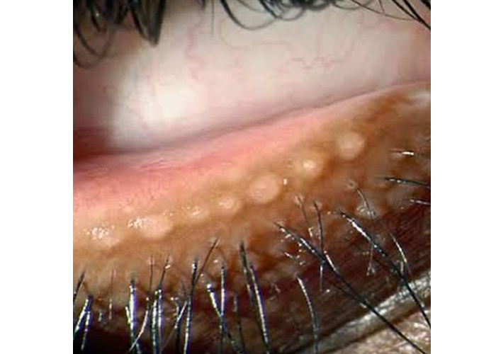 Avaliação integrada da produção, distribuição e drenagem do Filme Lacrimal, Anatomia das vias lacrimais

Anatomia funcional das vias lacrimais, destacando a glândula lacrimal, os pontos lacrimais, os canalículos, o saco lacrimal e o ducto nasolacrimal, estruturas responsáveis pela produção e drenagem fisiológica da lágrima.

O sistema lacrimal desempenha papel fundamental na manutenção da superfície ocular, proporcionando lubrificação, proteção imunológica, estabilidade óptica e conforto visual. Alterações discretas nesse sistema podem provocar sintomas importantes, como visão oscilante, ardor, sensação de areia, lacrimejamento excessivo e intolerância ao uso de lentes.

No Protocolo OptoPrime, a avaliação das vias lacrimais não é realizada apenas quando o paciente apresenta queixas de olho seco ou epífora (lacrimejamento excessivo dos olhos). Ela faz parte da investigação funcional da qualidade visual, pois a estabilidade do filme lacrimal influencia diretamente a refração, a sensibilidade ao contraste, a percepção de detalhes e o desempenho binocular.

Objetivos do Protocolo OptoPrime

A avaliação funcional das vias lacrimais busca:

Identificar alterações da produção lacrimal
A avaliação da produção lacrimal permite identificar alterações quantitativas da lágrima, fornecendo informações importantes sobre a lubrificação da superfície ocular e o equilíbrio do sistema lacrimal.

Avaliar a estabilidade do filme lacrimal, a estabilidade do filme lacrimal é essencial para manter a superfície ocular regular, favorecer a qualidade óptica e proporcionar conforto durante as atividades visuais.


Detectar sinais precoces de disfunção das glândulas palpebrais, a análise das glândulas palpebrais possibilita reconhecer precocemente alterações que podem comprometer a camada lipídica da lágrima e favorecer sua evaporação.

Investigar alterações da drenagem lacrimal, a investigação do sistema de drenagem lacrimal auxilia na identificação de alterações funcionais relacionadas ao escoamento da lágrima, contribuindo para uma avaliação clínica mais abrangente.


Diferenciar lacrimejamento reflexo de deficiência lacrimal
A diferenciação entre lacrimejamento reflexo e redução da produção lacrimal é importante para direcionar a interpretação dos sinais clínicos e orientar a conduta adequada durante a avaliação optométrica.

Reduzir a probabilidade de erros refracionais decorrentes da instabilidade do filme lacrimal
No Protocolo OptoPrime, a estabilização da superfície ocular antes do refinamento refracional contribui para aumentar a confiabilidade dos resultados e reduzir a probabilidade de variações induzidas pela instabilidade do filme lacrimal.


Anatomia Funcional

O sistema lacrimal é dividido em dois grandes componentes:

Sistema Secretor
O sistema secretor é formado por glândulas especializadas que produzem os diferentes componentes do filme lacrimal, contribuindo para a lubrificação, proteção e estabilidade óptica da superfície ocular.

Responsável pela produção da lágrima, inclui:

Glândula lacrimal principal
A glândula lacrimal principal é responsável pela maior parte da produção aquosa da lágrima, desempenhando papel importante na proteção, hidratação e resposta reflexa da superfície ocular.

Glândulas lacrimais acessórias
As glândulas lacrimais acessórias contribuem para a manutenção contínua do filme lacrimal, auxiliando na lubrificação fisiológica da superfície ocular durante as atividades diárias.

Glândulas de Meibômio
As glândulas de Meibômio produzem a camada lipídica do filme lacrimal, reduzindo a evaporação da lágrima e favorecendo maior estabilidade e conforto visual.

Glândulas de Zeis
As glândulas de Zeis estão associadas aos folículos ciliares e participam da produção de secreção lipídica que auxilia na proteção da margem palpebral.

Glândulas de Moll
As glândulas de Moll localizam-se na margem das pálpebras e contribuem para a manutenção do ambiente palpebral, integrando o sistema secretor da superfície ocular.

Células caliciformes da conjuntiva
As células caliciformes produzem mucinas que promovem a aderência da lágrima à superfície ocular, favorecendo a uniformidade do filme lacrimal e a qualidade óptica da córnea.


Cada estrutura contribui para a estabilidade do filme lacrimal.

Sistema Excretor
O sistema excretor é responsável pela drenagem fisiológica da lágrima, permitindo o escoamento adequado do excesso de secreção para a cavidade nasal.


Responsável pela drenagem fisiológica

Compreende:

Pontos lacrimais
Os pontos lacrimais constituem a porta de entrada do sistema de drenagem, captando a lágrima presente na margem palpebral durante o piscar.

Canalículos lacrimais
Os canalículos lacrimais conduzem a lágrima dos pontos lacrimais em direção ao saco lacrimal, participando do mecanismo fisiológico de drenagem.

Canalículo comum
O canalículo comum representa a união dos canalículos superior e inferior antes da chegada da lágrima ao saco lacrimal.

Saco lacrimal
O saco lacrimal funciona como reservatório temporário da lágrima antes de sua drenagem pelo ducto nasolacrimal.

Ducto nasolacrimal
O ducto nasolacrimal conduz a lágrima até a cavidade nasal, completando o processo fisiológico de drenagem do sistema lacrimal.


Qualquer obstrução nesse trajeto pode resultar em epífora e aumento do risco de infecções.

Estrutura do Filme Lacrimal

No Protocolo OptoPrime, o filme lacrimal é compreendido como uma estrutura dinâmica composta por três componentes funcionais.

Camada Lipídica, localizada externamente
Localizada na porção mais externa do filme lacrimal, a camada lipídica atua como uma barreira protetora contra a evaporação excessiva da lágrima, contribuindo para a estabilidade do filme lacrimal, a manutenção da superfície ocular e a otimização da qualidade óptica durante a formação da imagem retiniana.


Principais funções:

Reduzir evaporação
A camada lipídica, produzida principalmente pelas glândulas de Meibômio, reduz a evaporação da lágrima e favorece a estabilidade do filme lacrimal, desempenhando papel importante no conforto ocular e na qualidade da visão.

Estabilizar o filme lacrimal
A estabilidade do filme lacrimal mantém a superfície ocular uniformemente recoberta pela lágrima, reduzindo irregularidades ópticas e contribuindo para uma visão mais estável e confortável durante o piscar.

Melhorar a qualidade óptica da superfície ocular
Um filme lacrimal íntegro favorece a formação de uma superfície óptica regular sobre a córnea, reduzindo a dispersão da luz e contribuindo para maior nitidez, contraste e qualidade visual.

Sua deficiência favorece o olho seco evaporativo
a avaliação da camada lipídica do filme lacrimal auxilia na identificação de alterações que podem comprometer a estabilidade da superfície ocular, interferir na qualidade visual e influenciar a confiabilidade da avaliação refracional.


Camada Aquosa, representa a maior parte do volume lacrimal

Funções:

Hidratação da córnea
A camada aquosa do filme lacrimal mantém a hidratação contínua da córnea, preservando a transparência, a integridade do epitélio e o conforto durante as atividades visuais.

Transporte de nutrientes
A lágrima atua como meio de transporte para oxigênio, eletrólitos, proteínas e outros nutrientes essenciais, contribuindo para o metabolismo e a manutenção da superfície ocular.

Remoção de partículas
O fluxo fisiológico da lágrima auxilia na remoção de poeira, microrganismos e resíduos presentes na superfície ocular, favorecendo a limpeza e a proteção dos tecidos oculares.

Defesa imunológica
Além de lubrificar a superfície ocular, o filme lacrimal contém componentes de defesa que contribuem para a proteção contra agentes potencialmente nocivos e para a manutenção do equilíbrio da microbiota ocular.

Camada de Mucinas
A camada de mucinas permanece aderida ao epitélio ocular, promovendo maior aderência da lágrima à superfície da córnea e da conjuntiva, favorecendo a estabilidade do filme lacrimal.

As mucinas aumentam a capacidade de adesão da lágrima ao epitélio ocular, reduzindo áreas de instabilidade e melhorando a cobertura da superfície ocular.

Funções:

Fica aderida ao epitélio ocular a aderência da lágrima

A aderência da camada de mucinas ao epitélio ocular permite a distribuição uniforme da lágrima durante o piscar, contribuindo para uma superfície óptica mais regular e confortável. 

Uniformizar a superfície óptica
A distribuição homogênea das mucinas contribui para formar uma superfície refrativa mais regular, favorecendo a qualidade da imagem projetada na retina.

Promover melhor espalhamento do filme lacrimal.
Durante o piscar, a camada de mucinas facilita o espalhamento uniforme do filme lacrimal sobre a superfície ocular, contribuindo para maior estabilidade visual e conforto., Avaliação da superfície ocular, Protocolo optoprime, em, Óptica e Optometria